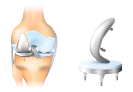 Dr.Rahul Khanna | Best orthopedic in udaipur | Orthopaedic Doctor | Orthopedic surgeon | Joint replacement surgeon | Udaipur | Joint Surgeon | Sports Injury Specialist | Kneeshoulderexpert in Udaipur | rotator cuff pain treatment | knee replacement surgery | top orthopedic doctor in udaipur