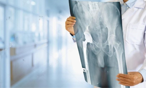 Hip replacement in udaipur | hip replacement doctor in udaipur | orthopedic doctor in udaipur
