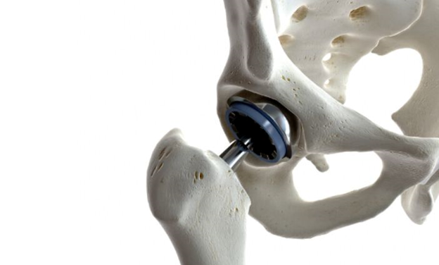 Hip replacement in udaipur | hip replacement doctor in udaipur | orthopedic doctor in udaipur