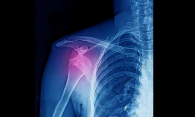 best orthopedic doctor | best orthopedic doctor in Udaipur | rotator cuff repair | rotator cuff pain treatment | rotator cuff pain | shoulder specialist
