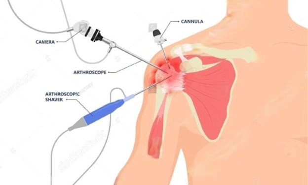 best orthopedic doctor | best orthopedic doctor in Udaipur | rotator cuff repair | rotator cuff pain treatment | rotator cuff pain | shoulder specialist