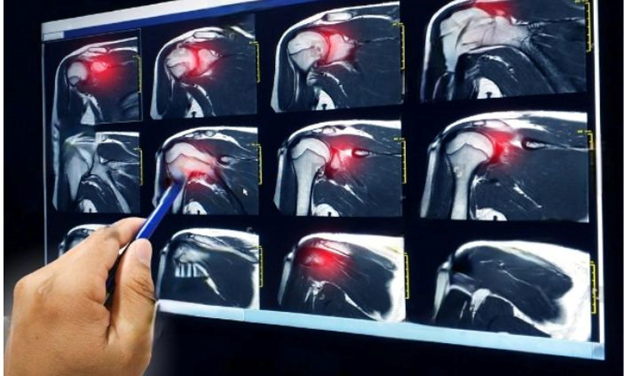 best orthopedic doctor | best orthopedic doctor in Udaipur | rotator cuff repair | rotator cuff pain treatment | rotator cuff pain | shoulder specialist