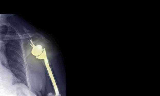best orthopedic doctor | best orthopedic doctor in Udaipur | rotator cuff repair | rotator cuff pain treatment | rotator cuff pain | shoulder specialist