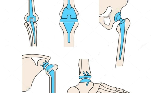 Joint replacement specialist | orthopedic doctor in udaipur | best joint specialist in udaipur | joint replacement specialist in udaipur