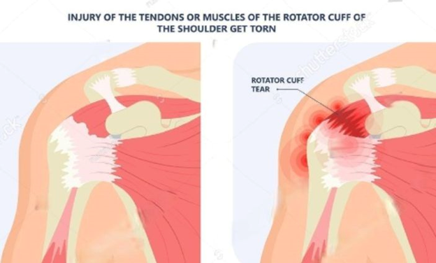 best orthopedic doctor | best orthopedic doctor in Udaipur | rotator cuff repair | rotator cuff pain treatment | rotator cuff pain | shoulder specialist