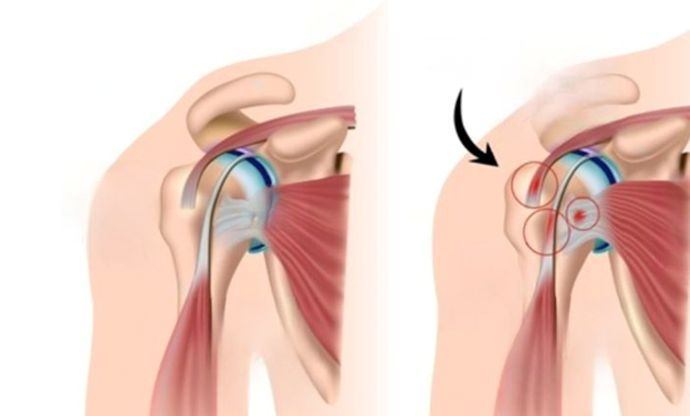 best orthopedic doctor | best orthopedic doctor in Udaipur | rotator cuff repair | rotator cuff pain treatment | rotator cuff pain | shoulder specialist
