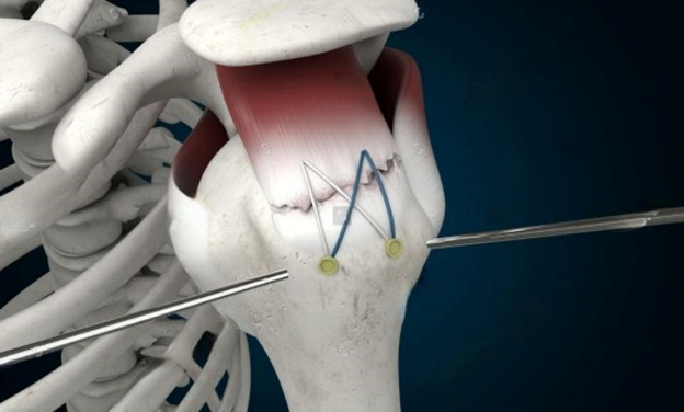 best orthopedic doctor | best orthopedic doctor in Udaipur | rotator cuff repair | rotator cuff pain treatment | rotator cuff pain | shoulder specialist udaipur
