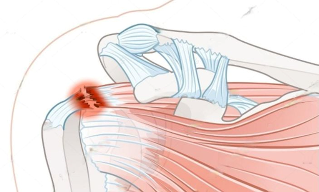 best orthopedic doctor | best orthopedic doctor in Udaipur | rotator cuff repair | rotator cuff pain treatment | rotator cuff pain | shoulder specialist