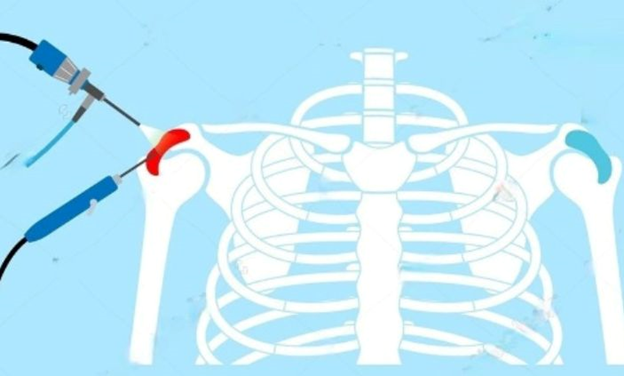 best orthopedic doctor | best orthopedic doctor in Udaipur | rotator cuff repair | rotator cuff pain treatment | rotator cuff pain | shoulder specialist