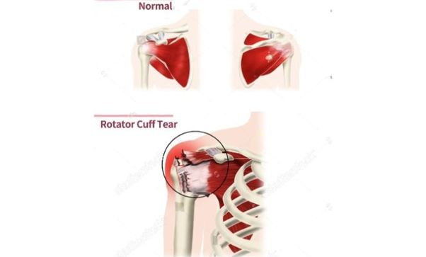 best orthopedic doctor | best orthopedic doctor in Udaipur | rotator cuff repair | rotator cuff pain treatment | rotator cuff pain | shoulder specialist