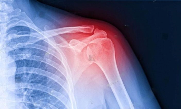best orthopedic doctor | best orthopedic doctor in Udaipur | rotator cuff repair | rotator cuff pain treatment | rotator cuff pain | shoulder specialist