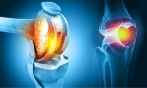 How to Accelerate Recovery Following Joint Replacement Surgery