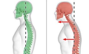How Bad Posture Can Cause Chronic Back Pain – and How to Correct It