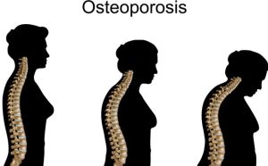 Osteoporosis in Women: Why Bone Health Matters More Than You Think